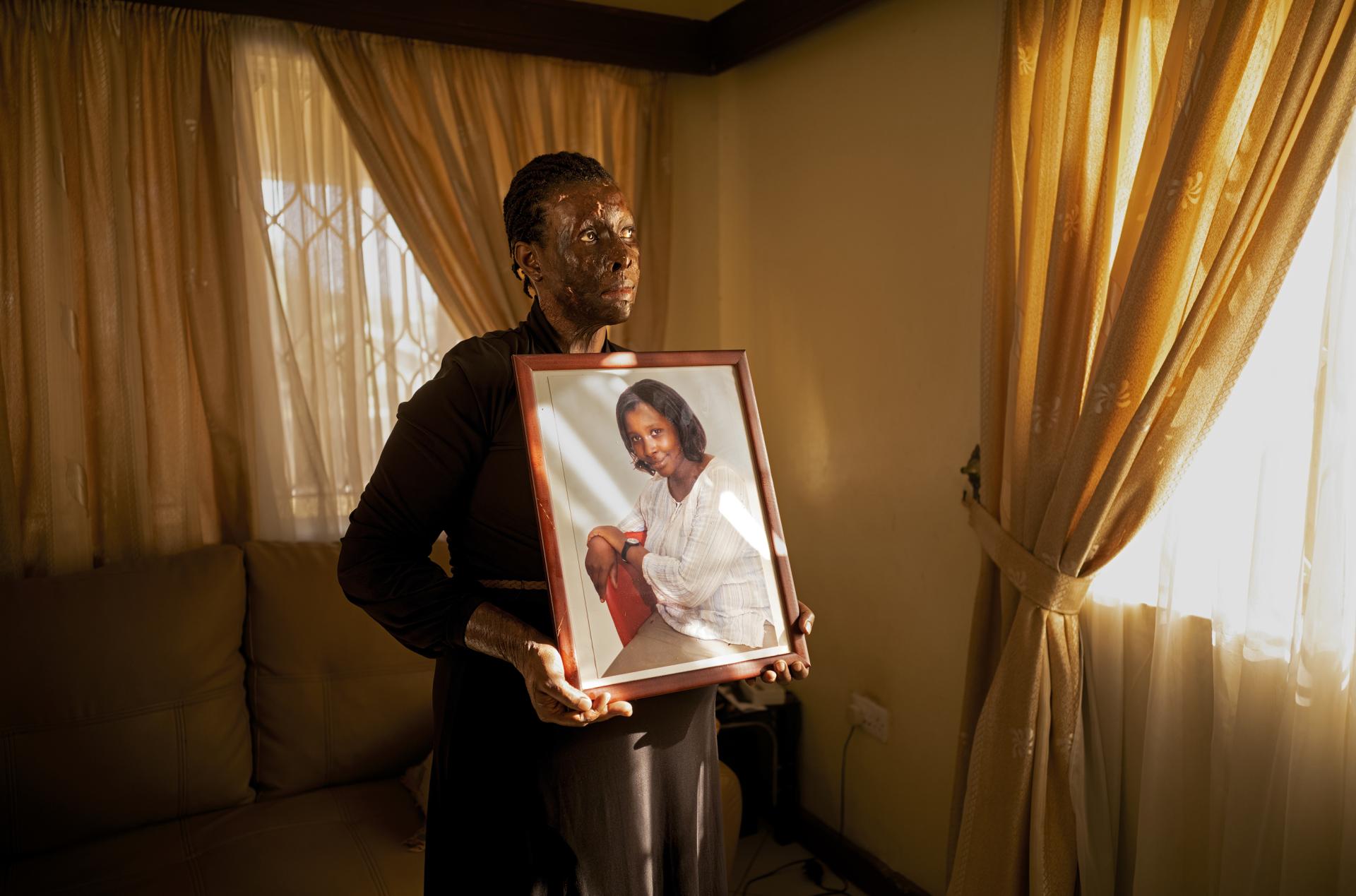 European Photography Awards Winner - Acid violence against women in Uganda